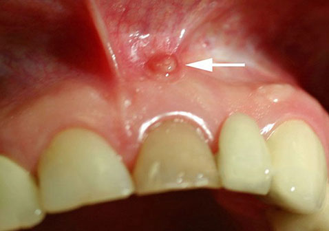 慢性牙周炎症状图片