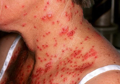 面部和颈部疱疹性湿疹的症状图片