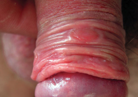 男性梅毒最先长在阴茎图片