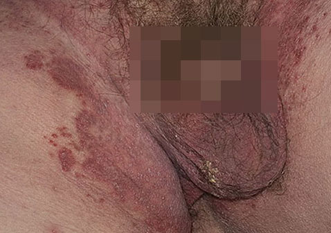 男性阴囊毛囊炎图片真菌感染