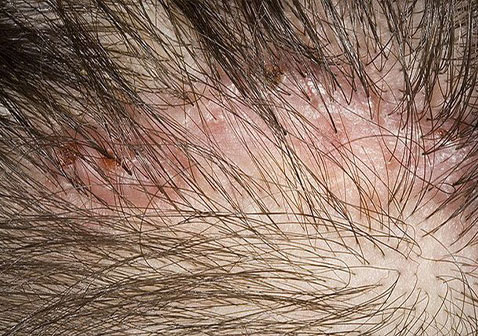 念珠菌毛囊炎的早期症状图片