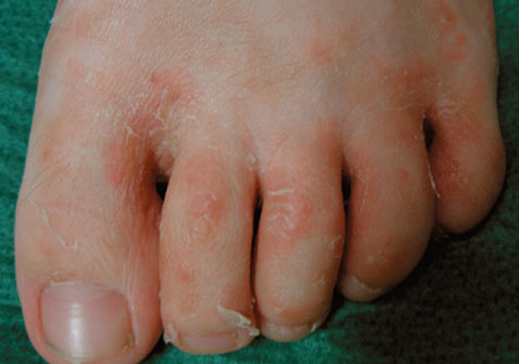 女性脚气初期图片和症状图片3