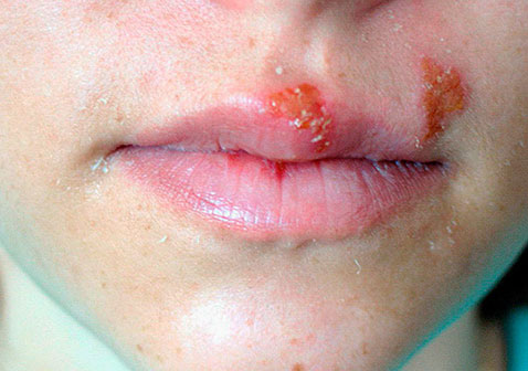 女性嘴角疱疹图片