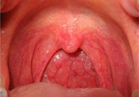 疱疹性咽峡炎发病初期图片