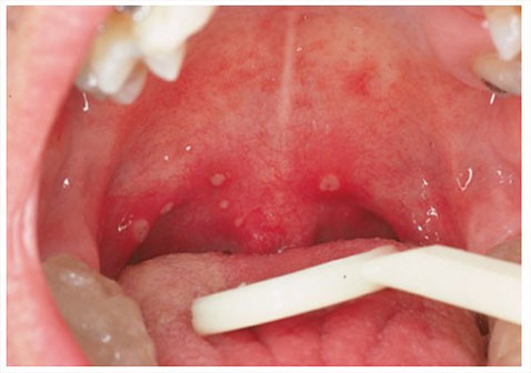 疱疹性咽峡炎溃疡期图片