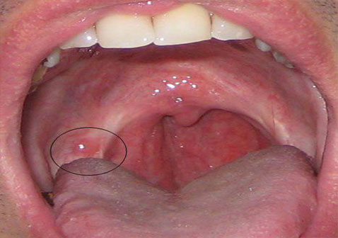 疱疹性咽峡炎疱疹期图片