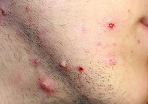 葡萄球菌毛囊炎的早期症状图片