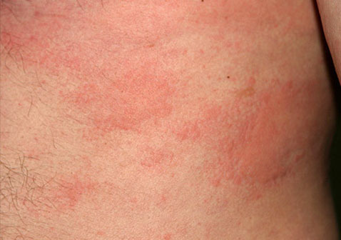 日光性荨麻疹初期症状图片4