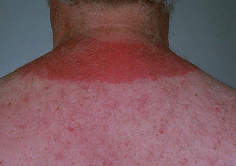 日光性荨麻疹图片和症状图