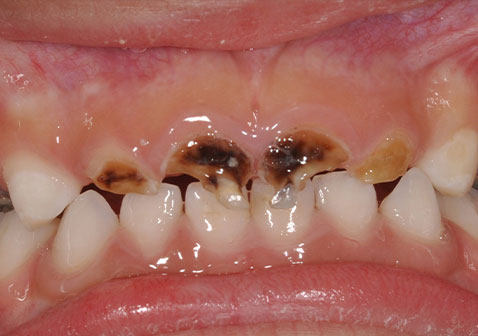 乳牙龋齿图片