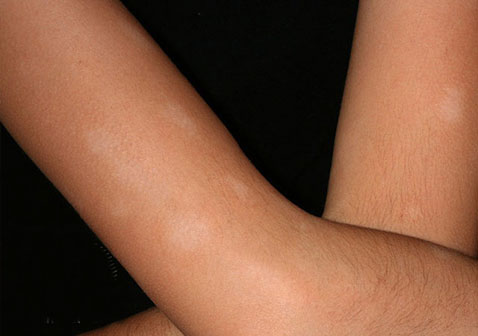 手臂春癣症状图片