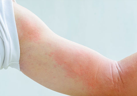 手臂日光性荨麻疹图片
