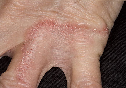 手藓类皮肤病图片2