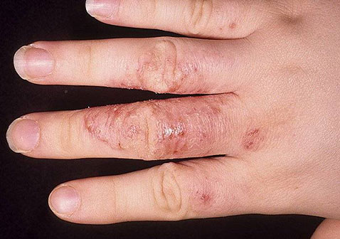 手藓类皮肤病图片3