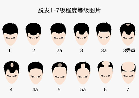 脱发1-7级程度图片