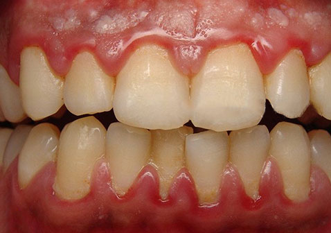 牙龈炎症状图片