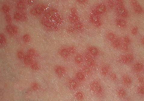 银屑病、痒疹和湿疹的区别图片之湿疹