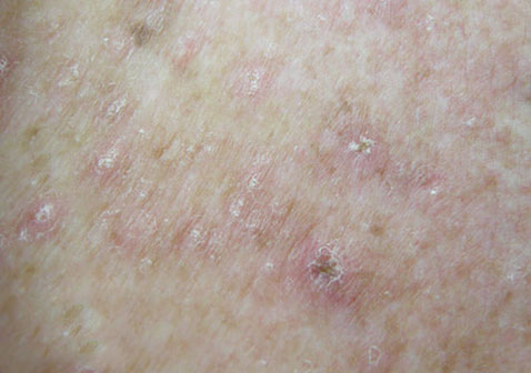 银屑病、痒疹和湿疹的区别图片之痒疹