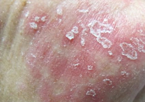 银屑病、痒疹和湿疹的区别图片之银屑病