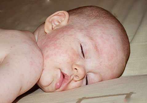 儿童9种常见的皮肤病图片7小儿急疹图片