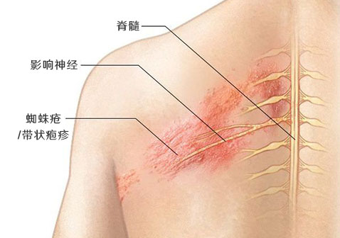 蜘蛛疮初期症状图片