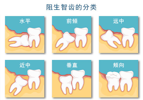 阻生智齿图片分类