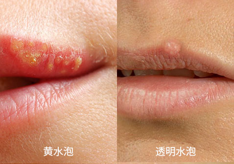 嘴上疱疹和上火水泡的区别图片对比