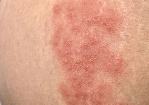 后背带状疱疹图片