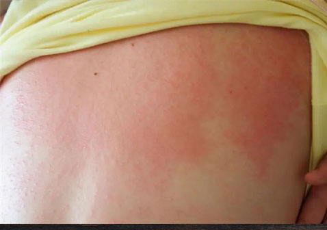 后背过敏性皮肤病图片