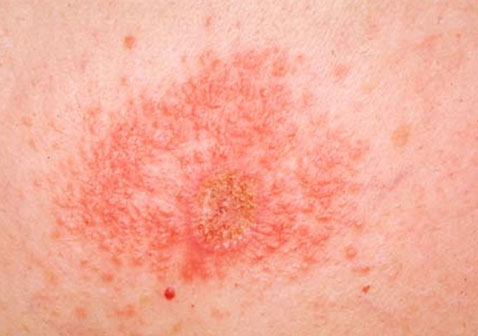 后背接触性皮炎图片