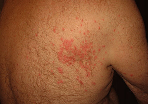 后背毛囊炎图片