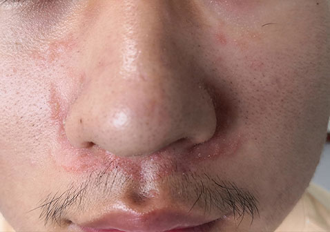 鼻子脂溢性皮炎初期图片