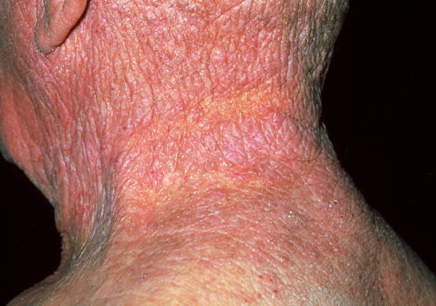 脖子慢性湿疹严重图片