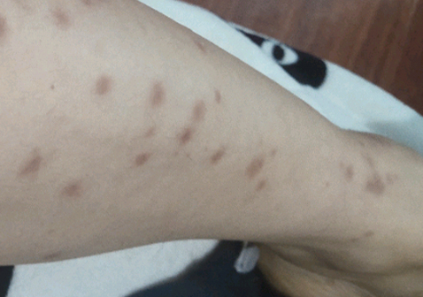 点滴型银屑病消退特点图2