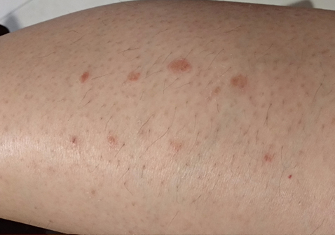 点滴型银屑病消退特点图3