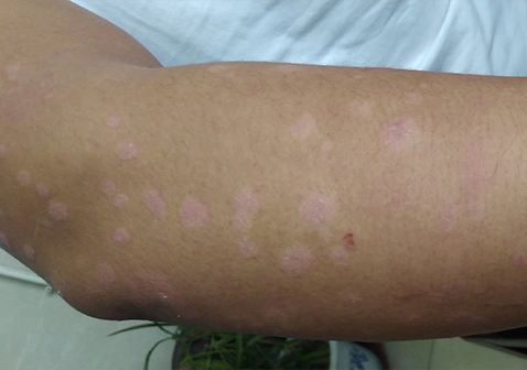 点滴型银屑病消退特点图