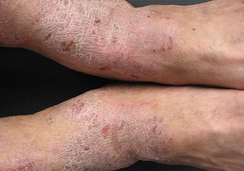 脚踝对称性皮炎湿疹图片