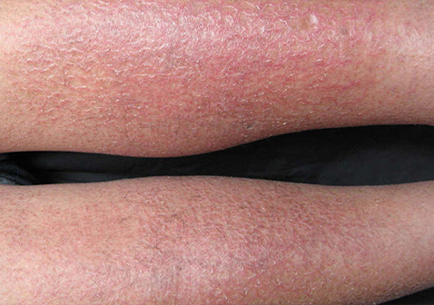 腿部对称性皮炎湿疹图片