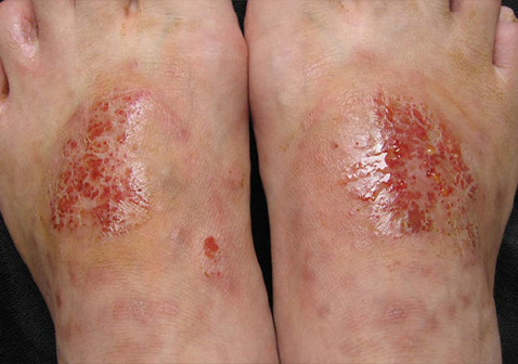 脚部对称性皮炎湿疹图片