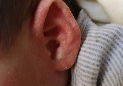 耳朵脂溢性皮炎初期图片
