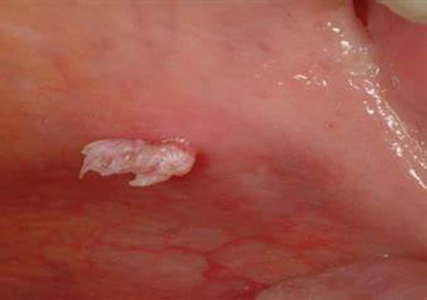 喉咙HPV感染图片