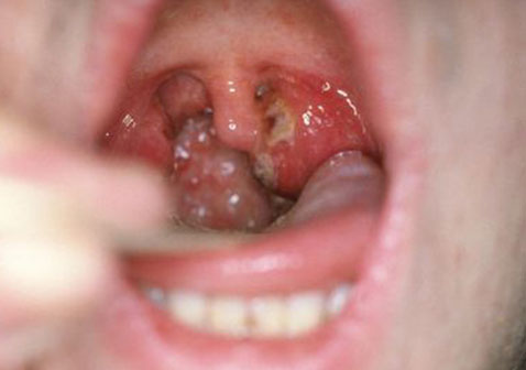 喉咙淋病图片