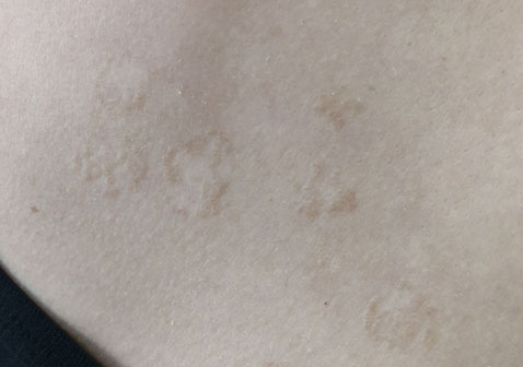 汗癣圆形斑疹样子图片