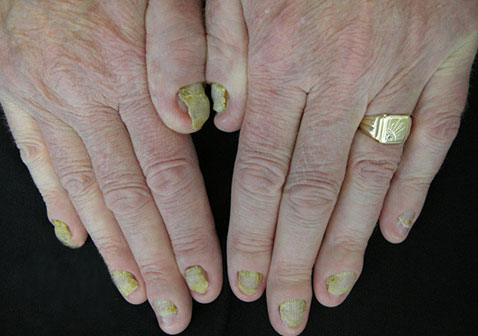 黄甲综合症图片