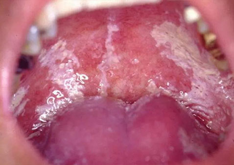 急性红斑型念珠菌性口炎图片