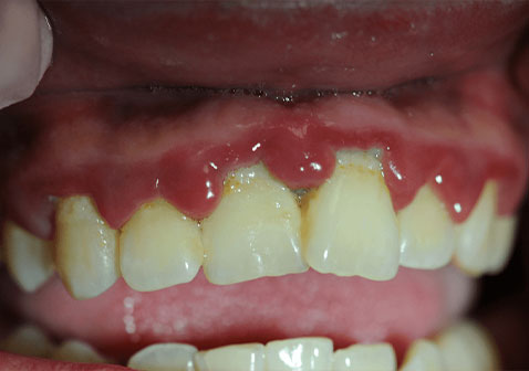 急性坏死性溃疡性牙龈炎图片