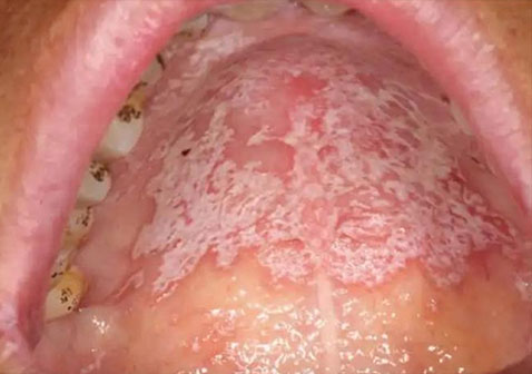 急性假膜型念珠菌性口炎图片