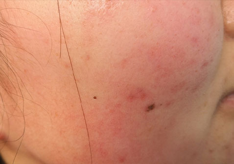 急性湿疹图片初期症状图片