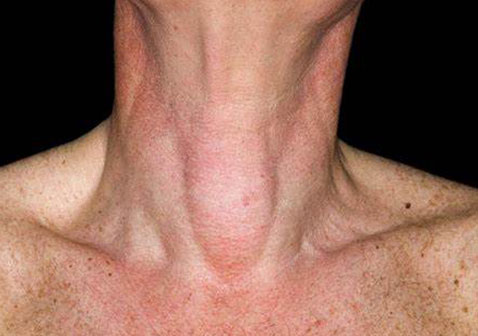 甲状腺结节真实照片
