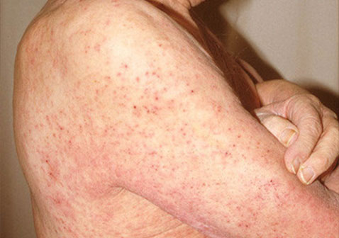 肩膀上有螨虫的图片2